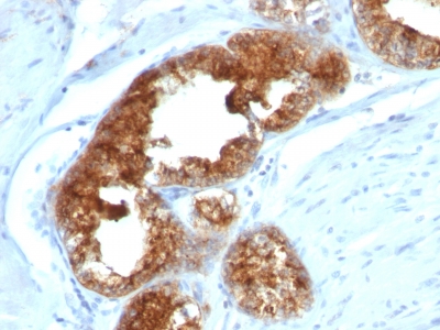 FFPE human prostate carcinoma sections stained with 100 ul anti-TAG-72 / CA72.4 (clone B72.3 + CA72/733) at 1:400. HIER epitope retrieval prior to staining was performed in 10mM Citrate, pH 6.0.